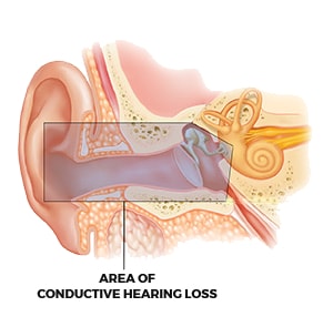 Conductive Hearing Loss