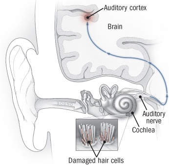 Understanding Tinnitus