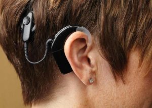 Cochlear Implants