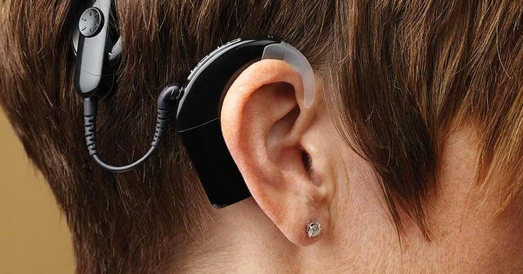 Cochlear Implants: The Only Medical Device Capable Of Replacing A Sense