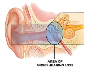 Mixed Hearing Loss