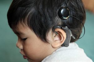 Process of Getting Cochlear Implants