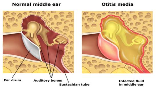 Transient Hearing Loss In Children