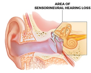 Sensorineural Hearing Loss