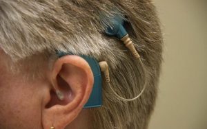 Hearing Aids Vs Cochlear Implants
