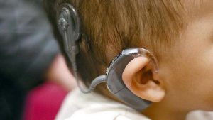 Cochlear Implants