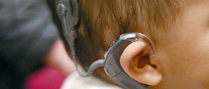 Cochlear Implants