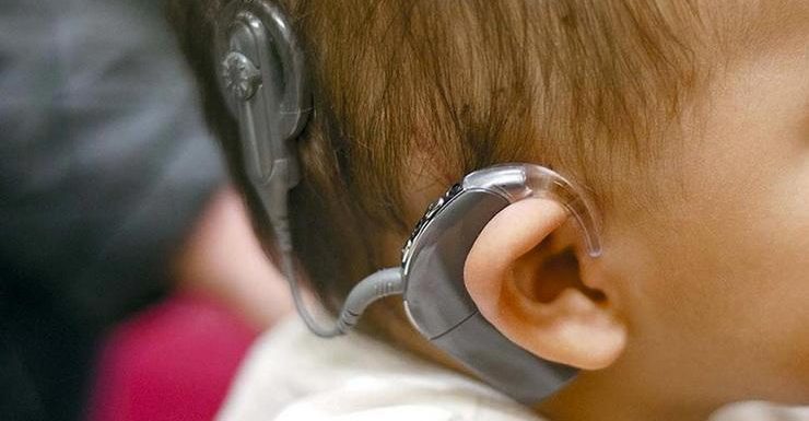 Cochlear Implants