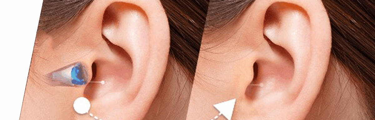 Know Everything About invisible Hearing Aids