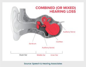 Mixed hearing loss