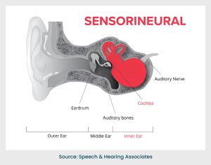 Sensorineural hearing loss