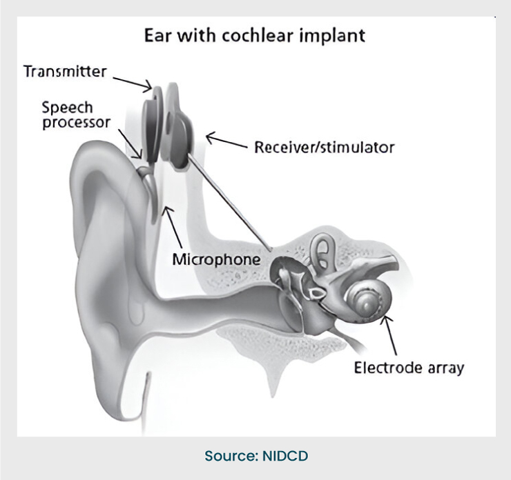 cochlear implant 