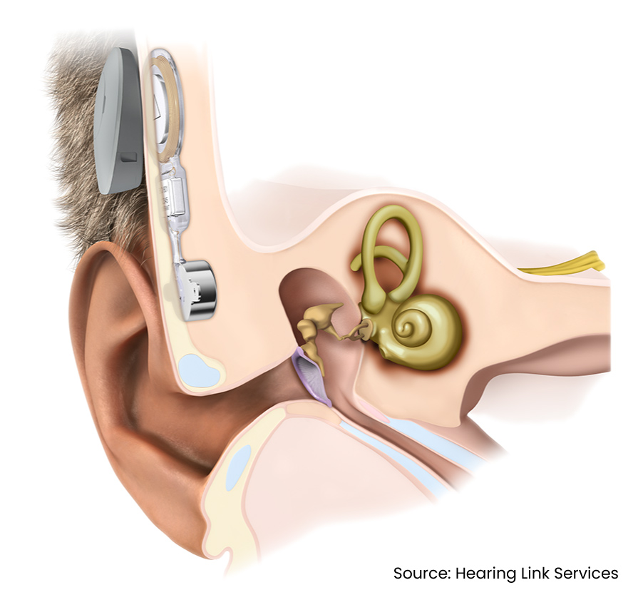 Understanding bone conduction hearing aids