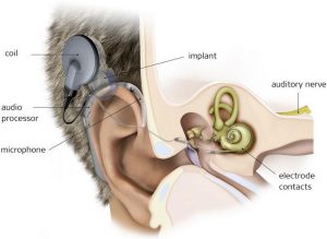cochlear implant parts - how cochlear implants work