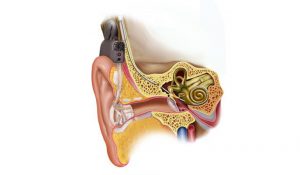cochlear-implant-surgery