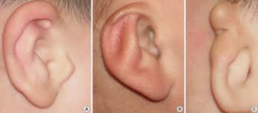 External ear abnormalities