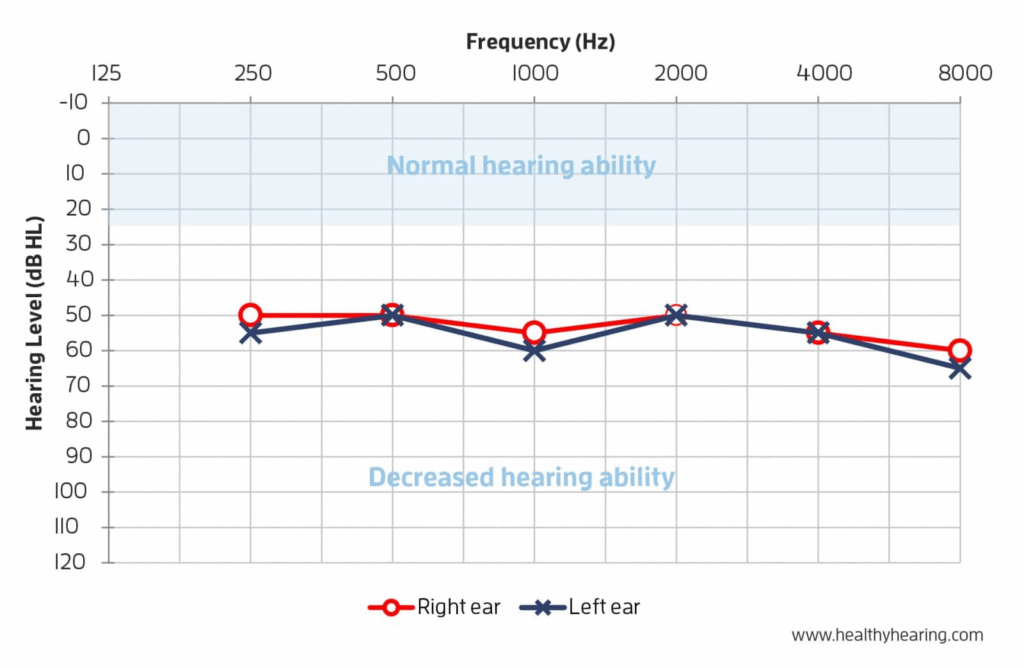 Graph of hearing levels