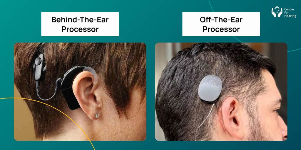 Other hearing aids vs Cochlear Implant